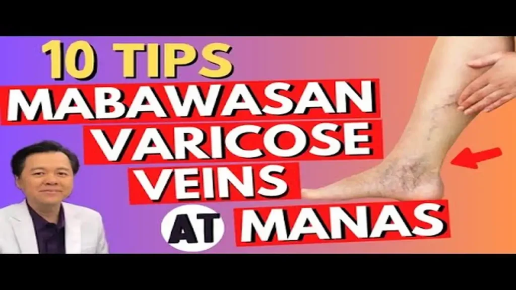 Mabisang Paraan Para Mapawi ang Varicose Veins at Manas sa Binti