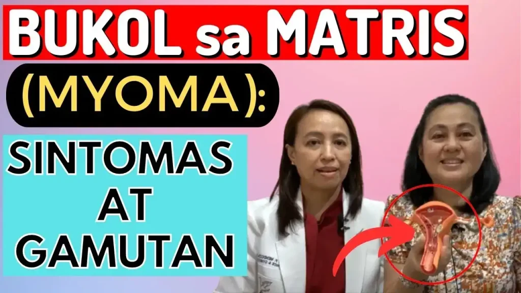 Kalusugan ng Kababaihan: Gabay at Lunas sa Myoma sa Matris