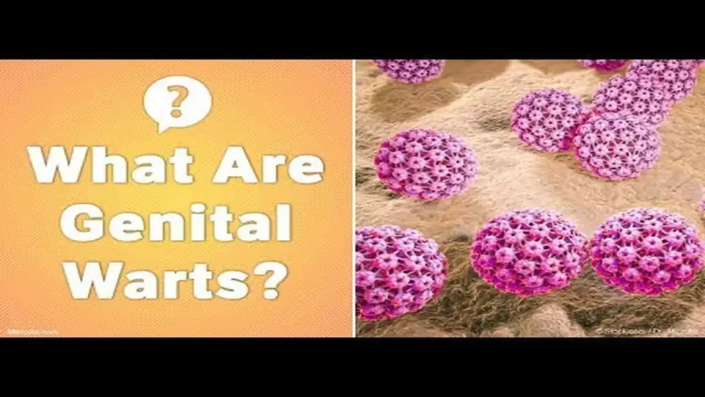 Kalusugan ng Kababaihan: Gabay sa Pag-iwas sa Genital Warts at Kanser