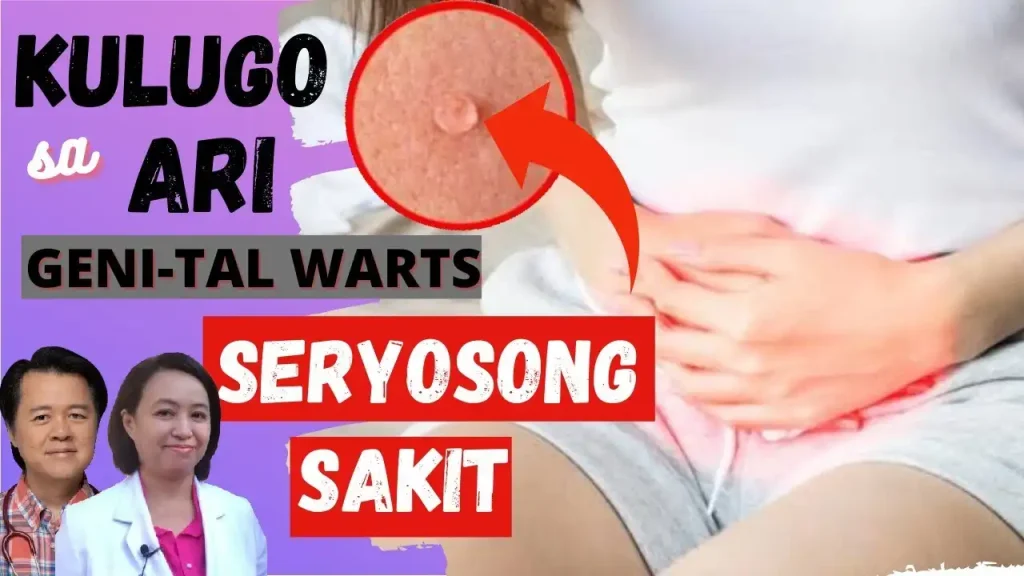 Kalusugan ng Kababaihan: Gabay at Lunas sa Genital Warts