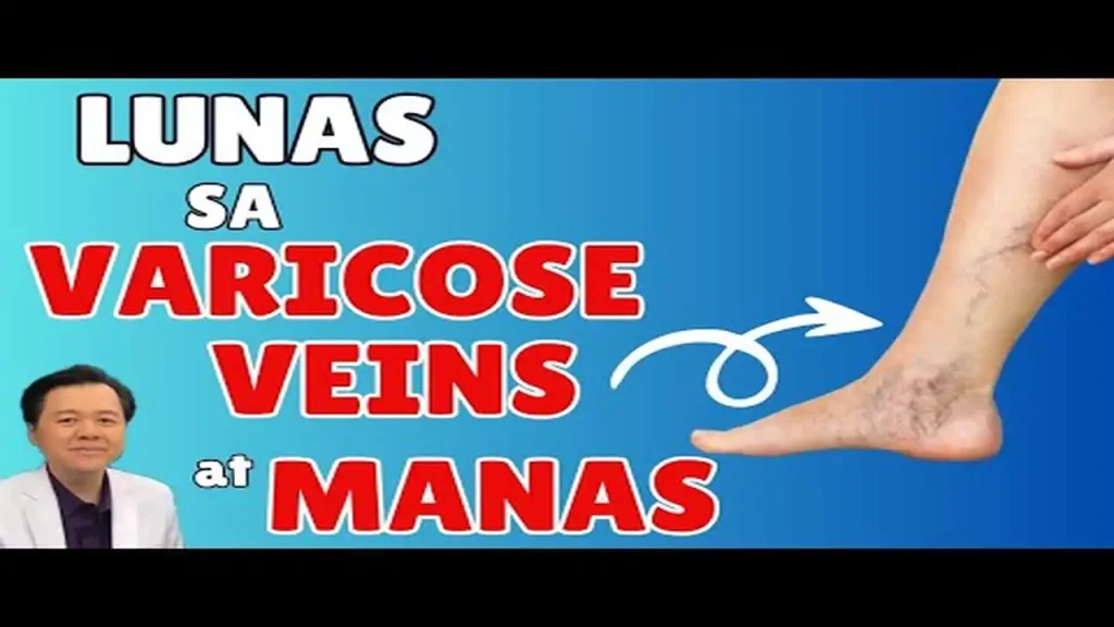 Tamang Lunas sa Varicose Veins at Pamamanas ng Paa