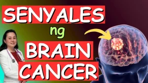 Mga Babalang Senyales ng Brain Cancer na Dapat Bantayan