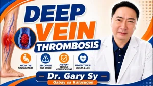 Mapanganib na Blood Clot sa Paa: Sintomas at Lunas sa DVT