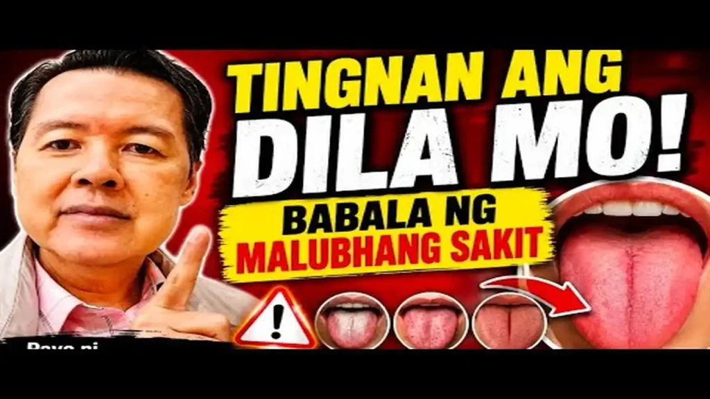 Babala ng Sakit sa Katawan na Makikita sa Dila