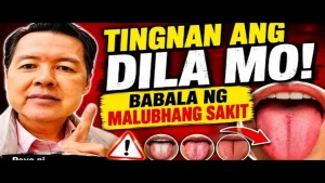 Babala ng Sakit sa Katawan na Makikita sa Dila