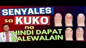 Babala sa Kuko: Mga Pagbabago na Senyales ng Malalang Sakit